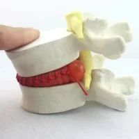 Disc Herniation Hernia Model Model 2