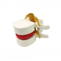 Disc Herniation Hernia Model Model 2