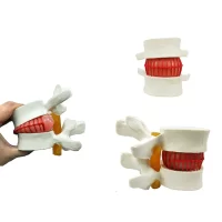 Disc Herniation Hernia Model Model 2