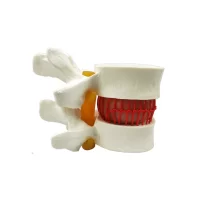 Disc Herniation Hernia Model Model 2