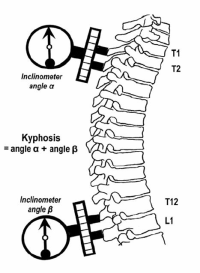 Inclinometer Lordosis and Kyphosis Measurement Meter